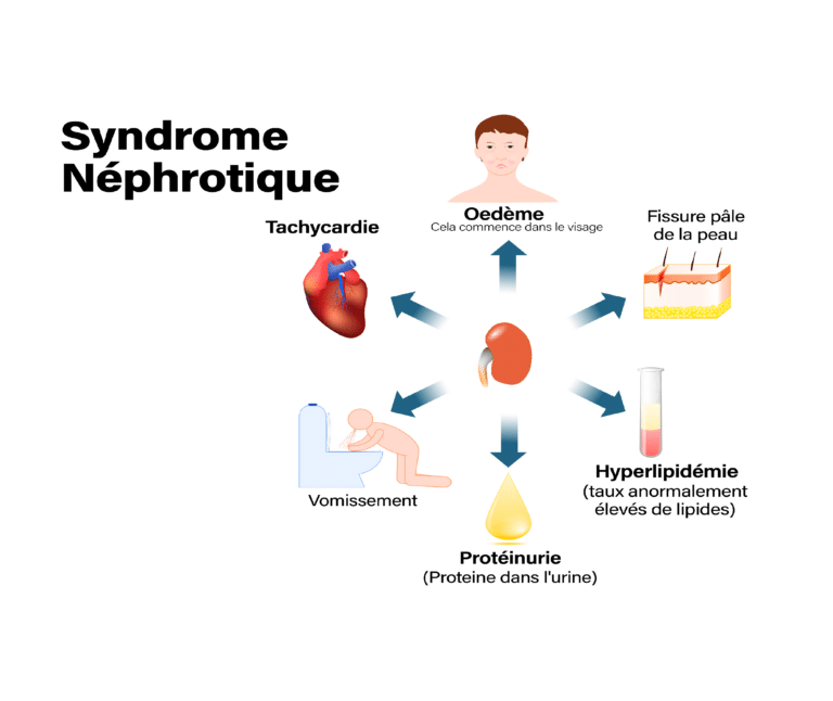 découvrez les impacts de la néphropathie diabétique sur la population polynésienne, une condition médicale associée au diabète, ses causes, ses symptômes et les solutions adaptées pour améliorer la santé des personnes concernées.
